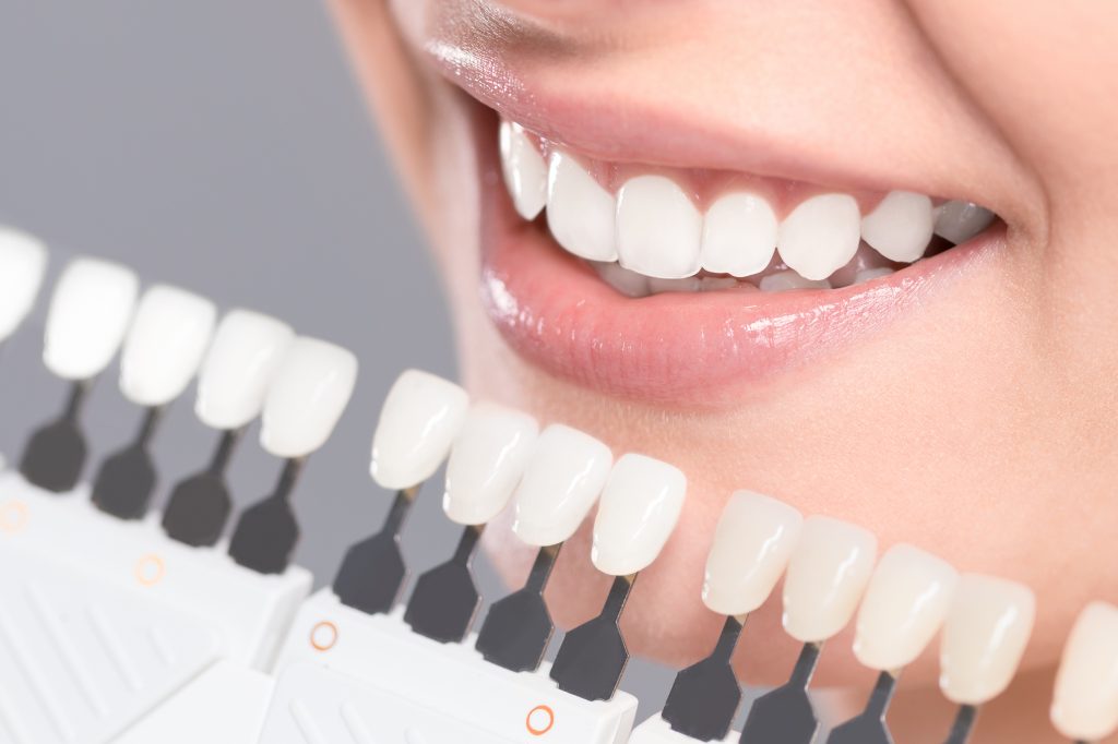 Dental Veneers Healthway Dental clinic