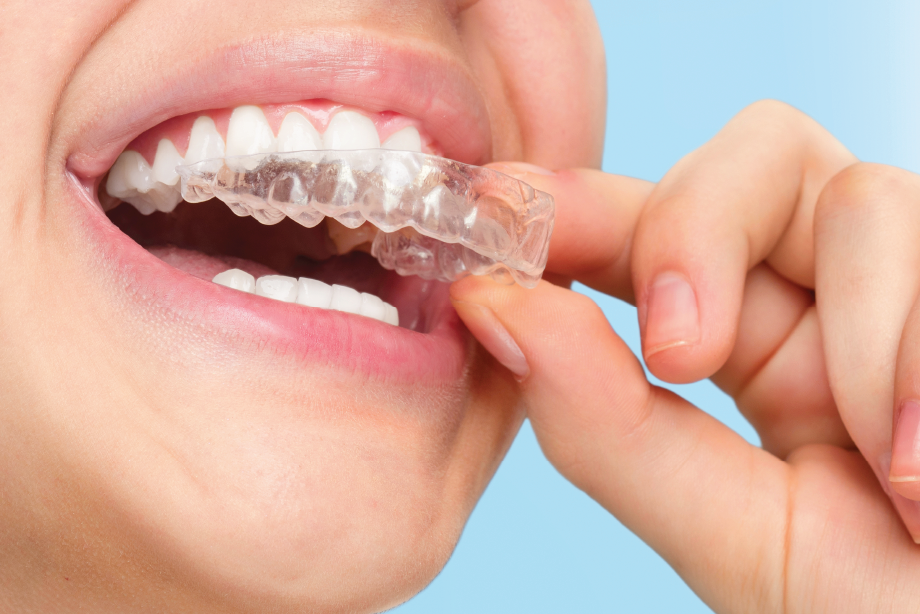 Dental Braces, Aligners, Retainers