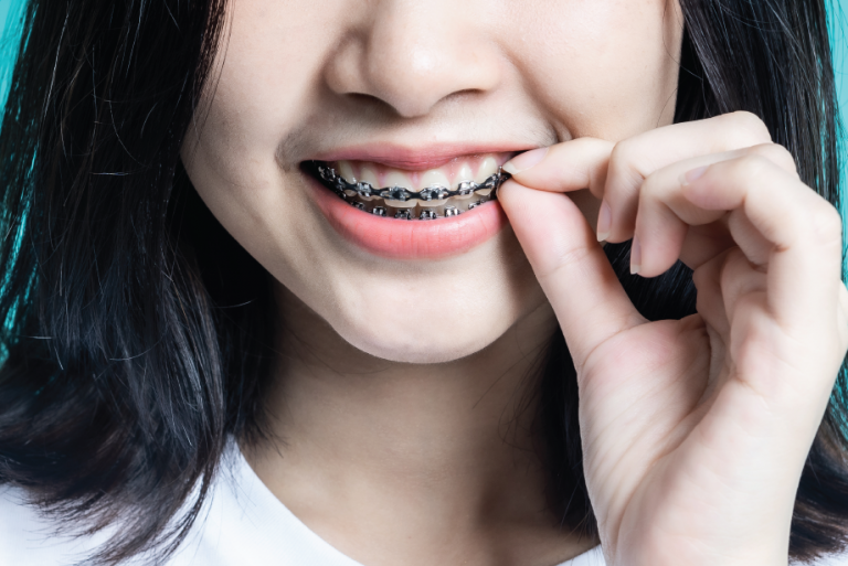 Dental Braces, Aligners, Retainers