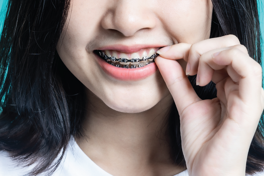 Dental Braces, Aligners, Retainers Healthway Dental Clinics