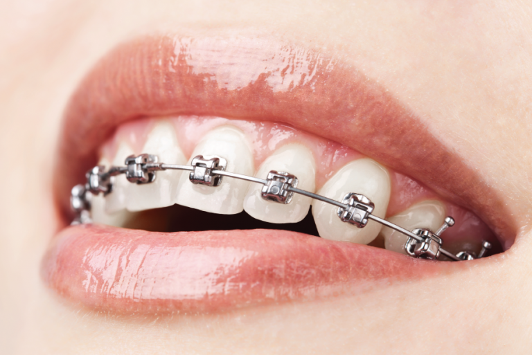 Dental Braces, Aligners, Retainers